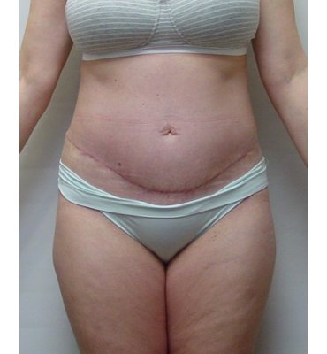abdominoplasty front view after